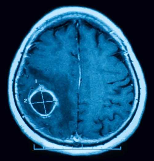 Абсцесс мозга на МРТ
