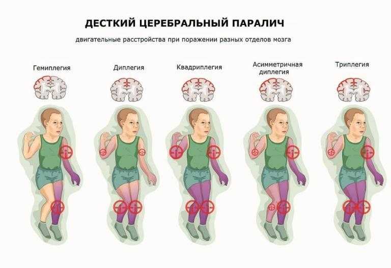 Формы дцп картинки