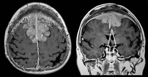 Опухоль из оболочек мозга на МРТ