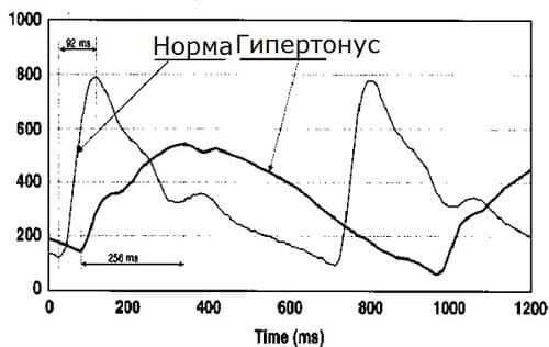 Разница РЭГ в норме и при гипертонусе сосудов