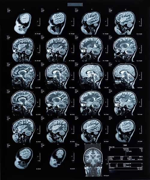 Серия снимков мозга на МРТв разных проекциях