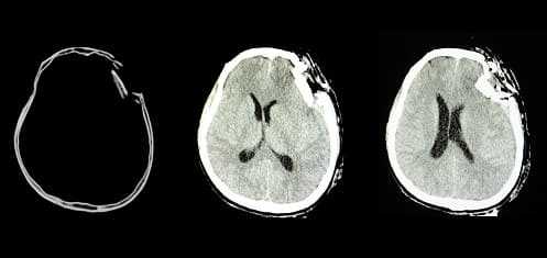 Снимок поврежденного мозга на КТ
