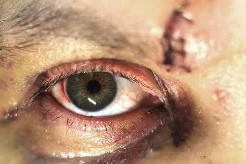 Травма глаза и шов кожи глазницы