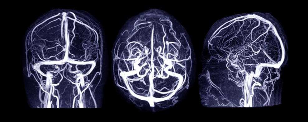 Венозная система мозга наМРТ с контрастированием