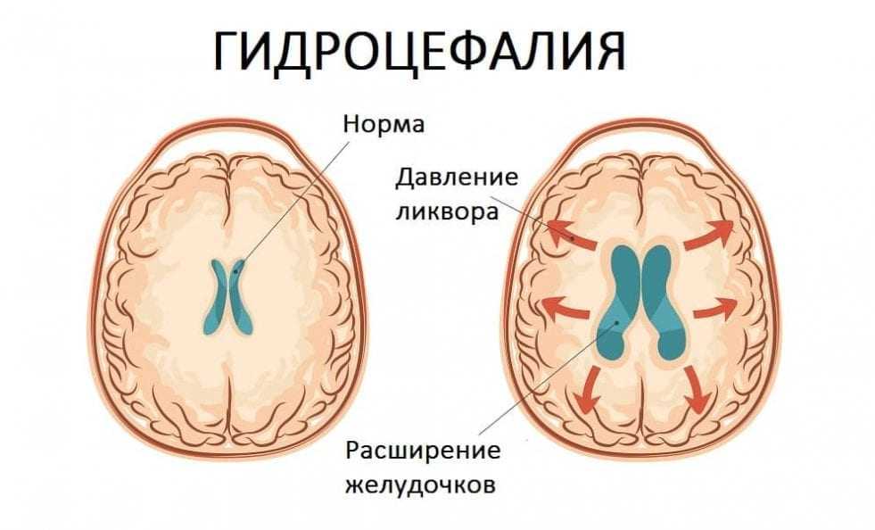 Киста эпифиза - причины возникновения, симптомы, диагностика, лечение.