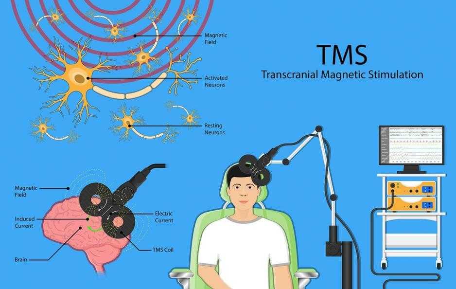 Транскраниальная магнитная стимуляция (ТМС) в лечении депрессии