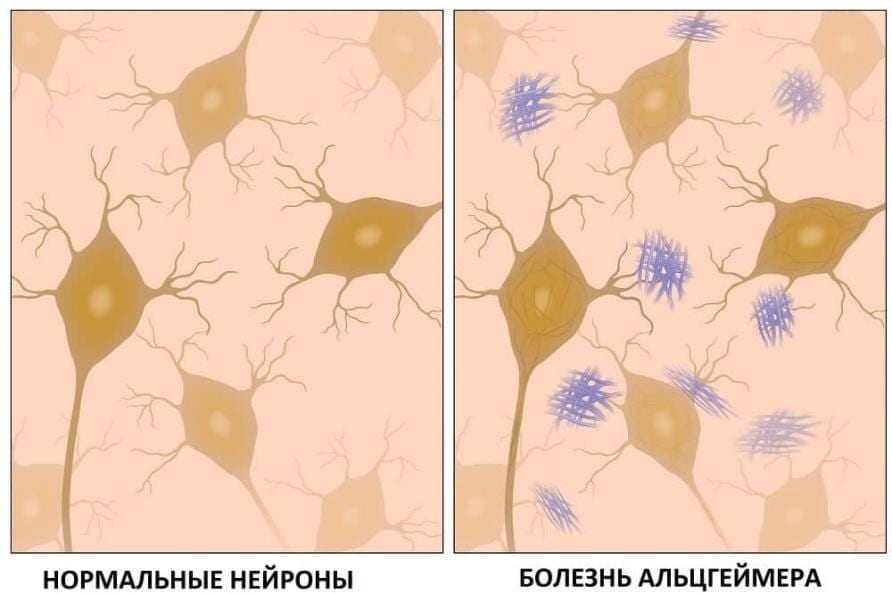 Скопления амилоида в нейронах