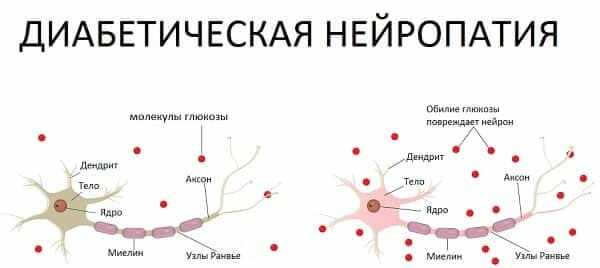 Гипергликемия отрицательно влияет на нервные клетки