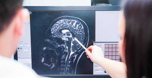 Поиск причины эпилепсии на МРТ