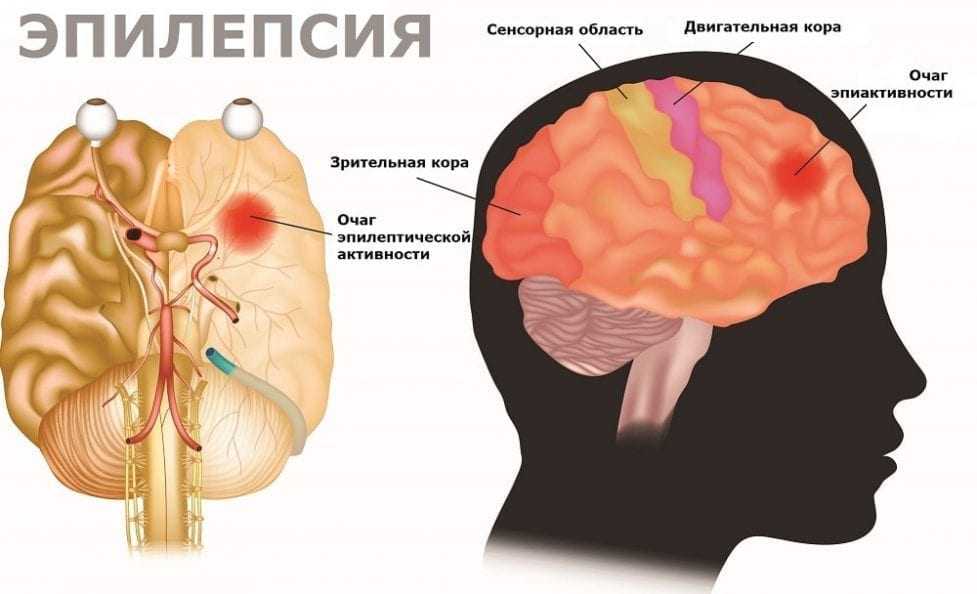 Схема расположения очага эпилепсии в мозгу