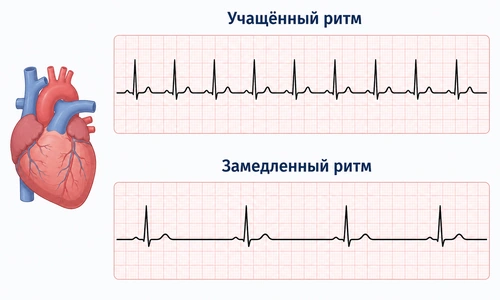 Тахиаритмический и брадиаритмический варианты ВСД Схема тахикардии и брадикардии на ЭКГ