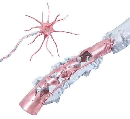 Поврежденный рубцовой тканью нейрон