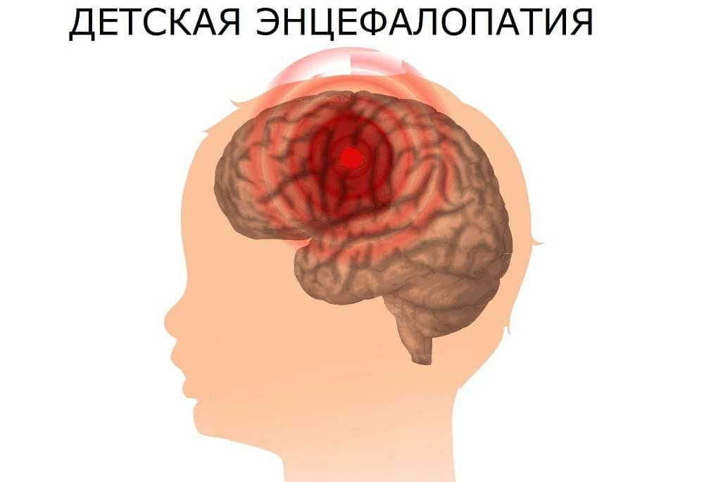 Очаг энцефалопатии у младенца
