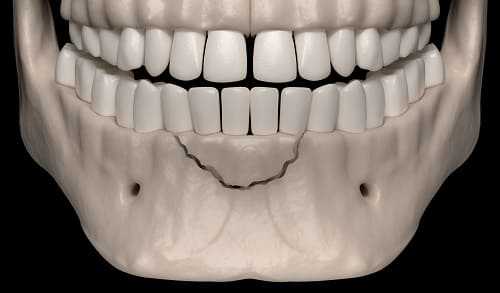 Схема перелома нижней челюсти