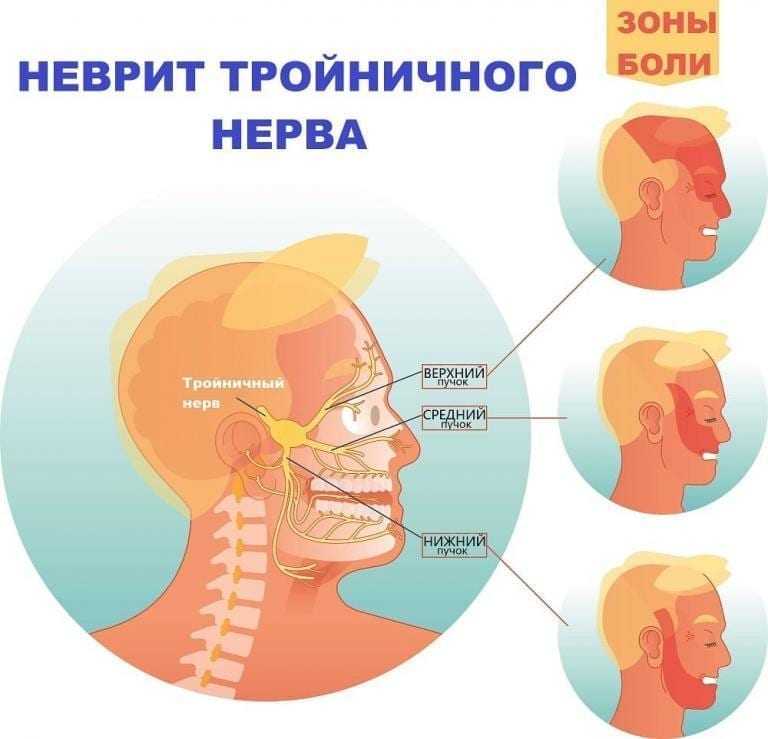 Воспаление тройничного лицевого нерва фото