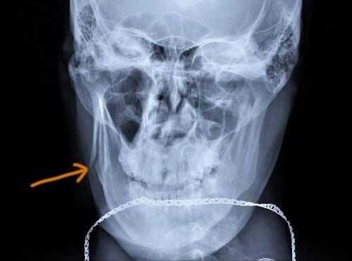 Место перелома челюсти на рентгенограмме