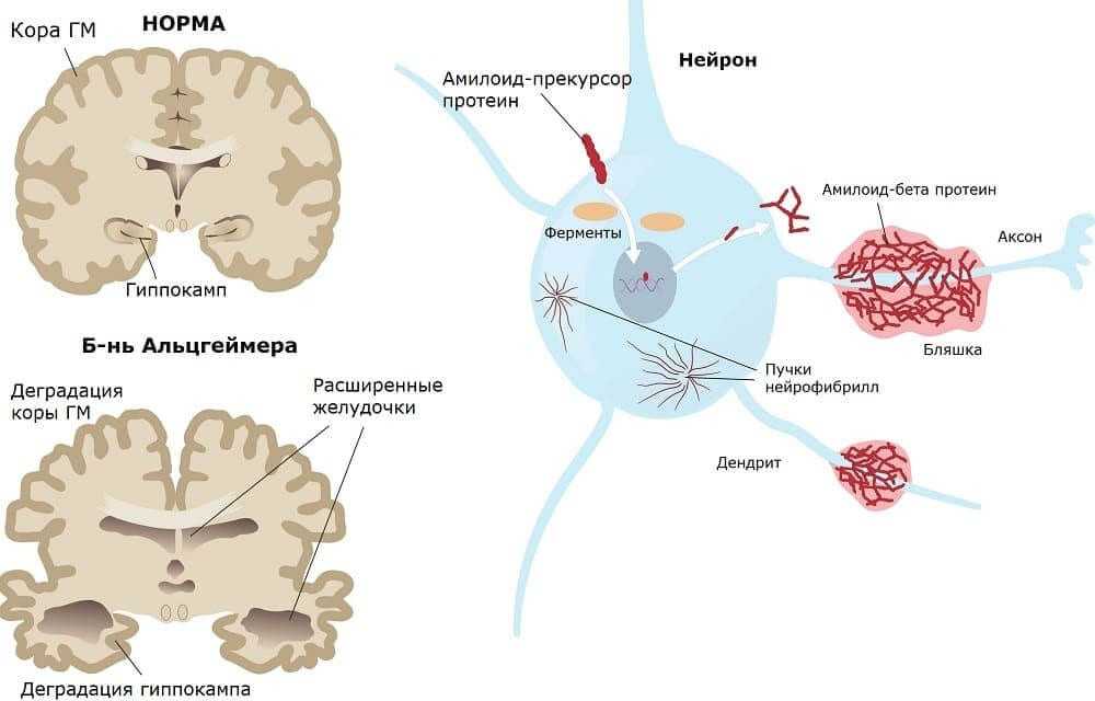 Alzheimer cetosis