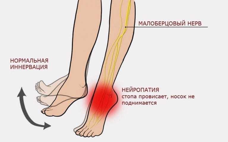 Моторная аксонопатия малоберцового нерва