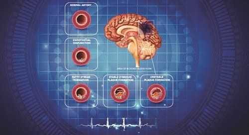Сужение мозговых сосудов атеросклерозом