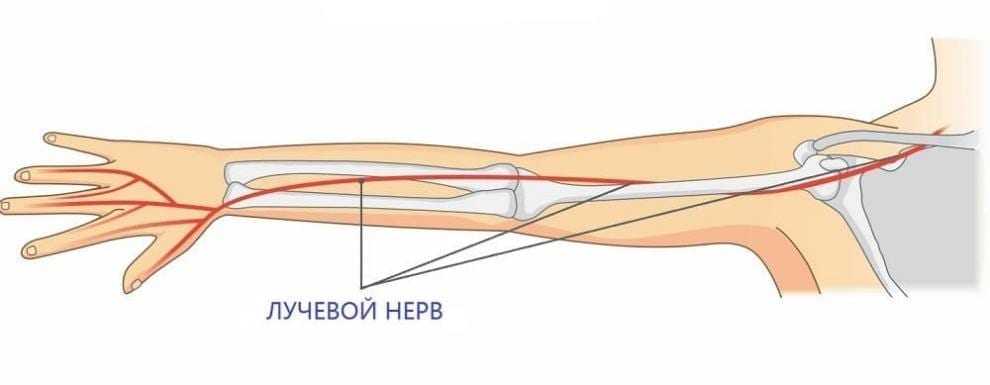 Нейропатия лучевого нерва. Неврит лучевого нерва руки.