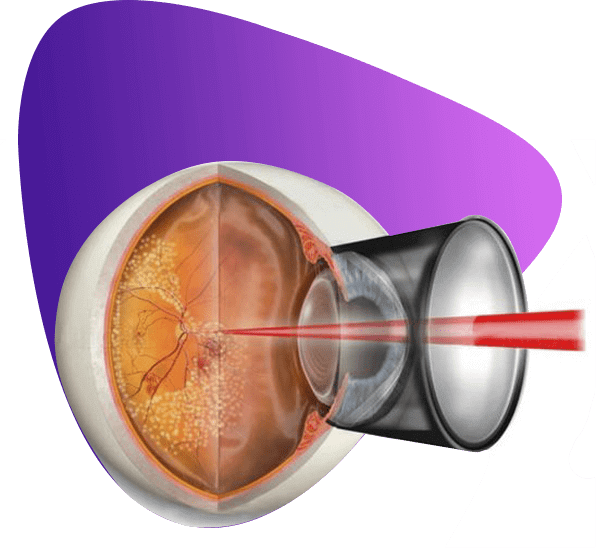 Глаз после лазерной коагуляции сетчатки. Лазерокоагуляция сетчатки. Паравазальная лазеркоагуляция сетчатки. ППЛК сетчатки реабилитация.