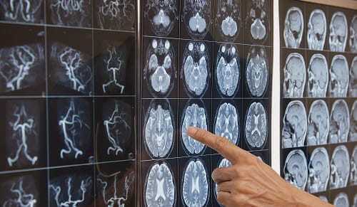 Оценка кровоснабжения мозга на МРТ