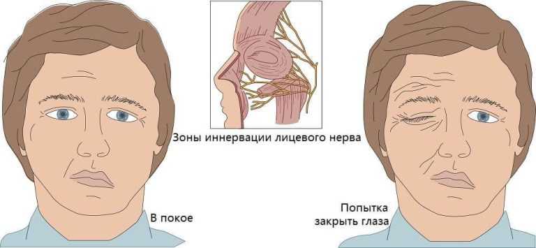 Схема лечения неврита лицевого нерва