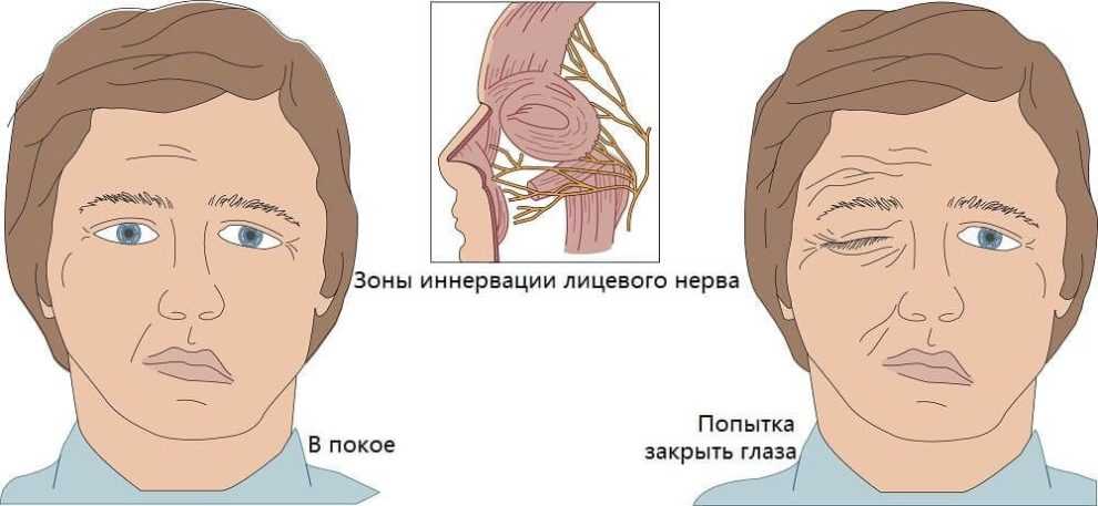 Неврит лицевого нерва симптомы и лечение у взрослых причины фото