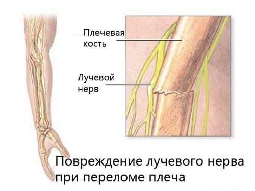 Травма лучевого нерва при переломе плечевой кости