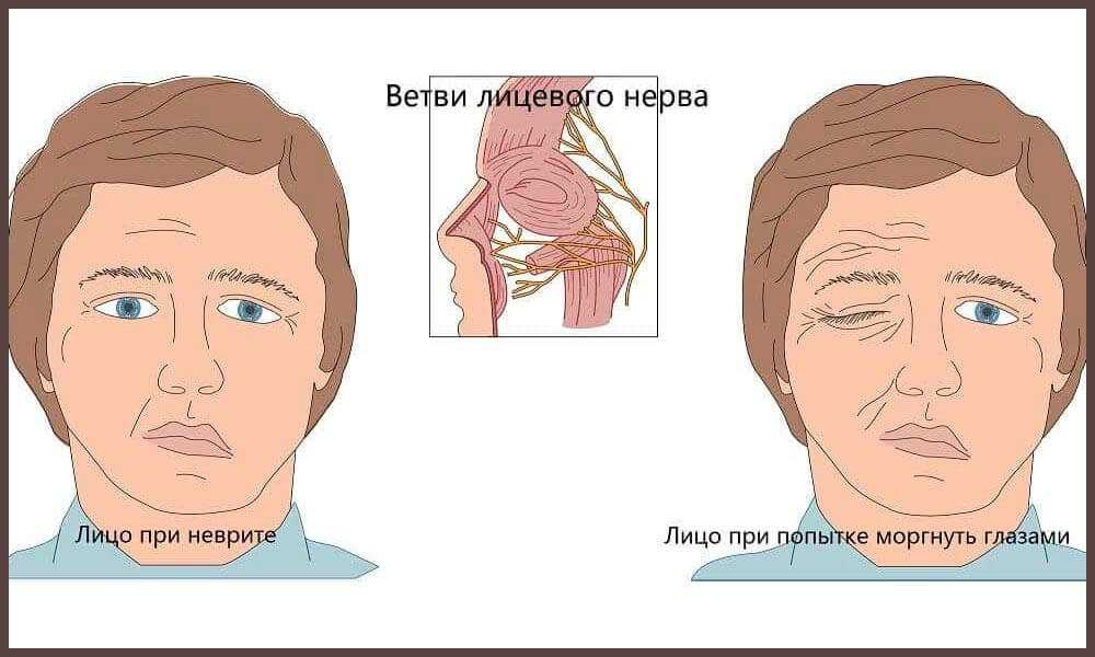 Симптомы неврита лицевого нерва