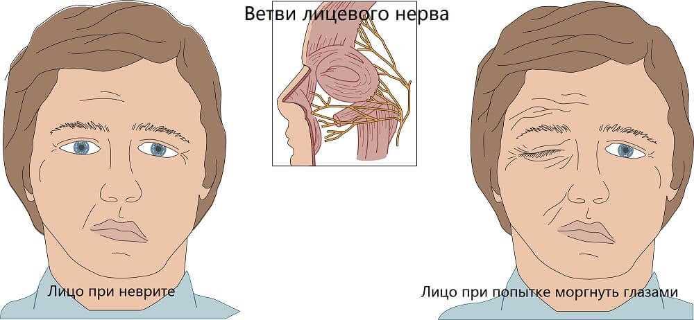 Симптомы пареза лицевого нерва