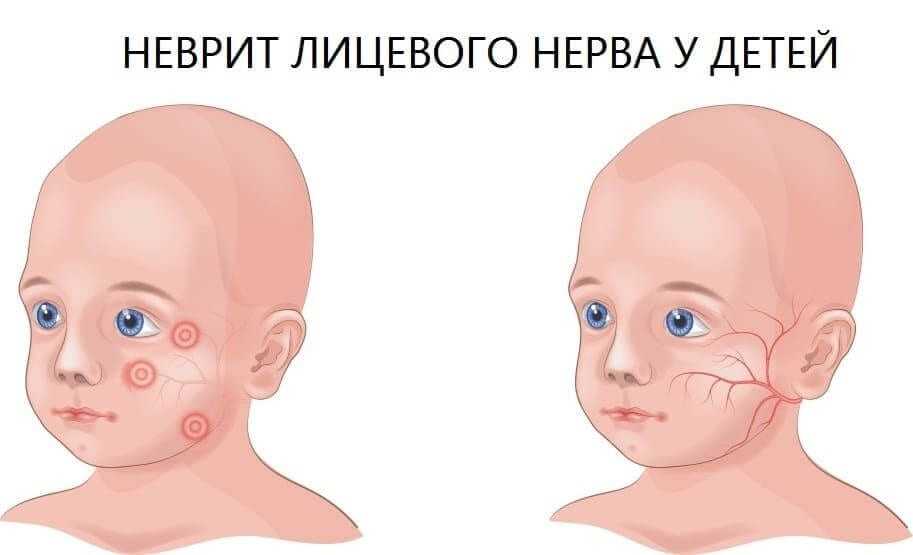 Анатомия лицевого нерва у детей