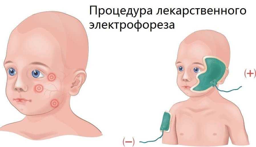 Лечение лицевого неврита электрофорезом