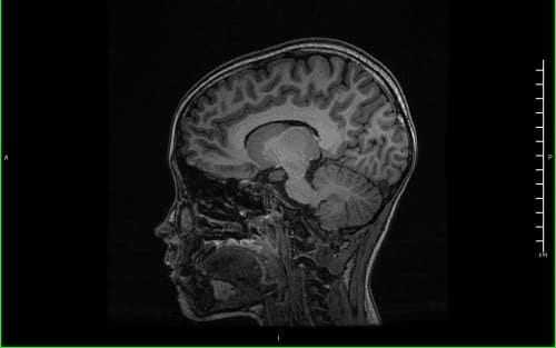 Мозг ребенка на МРТ