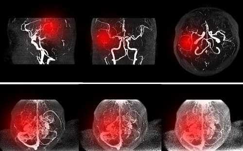 Сосуды мозга на МРТ сканере