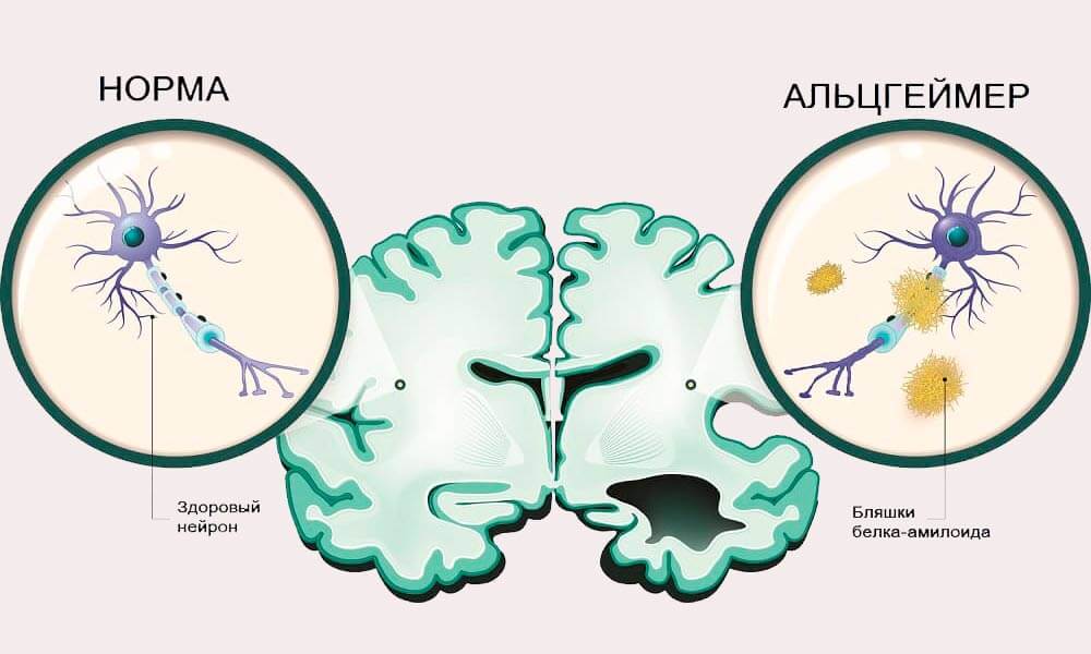 Сравнение здоровых и больных Альцгеймером нейронов