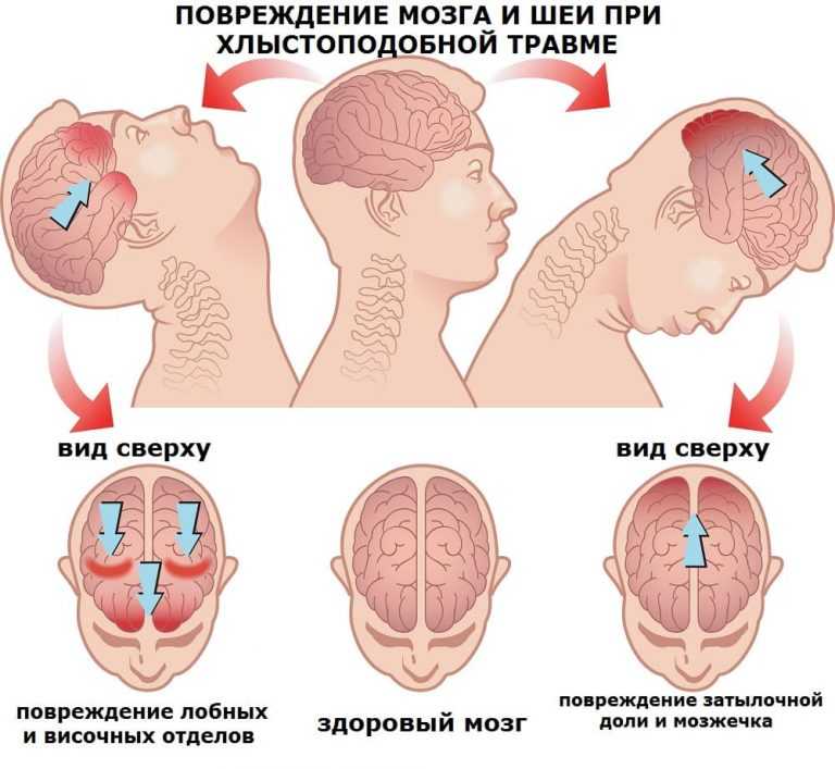 Локальные повреждения мозга