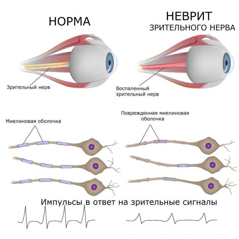 Неврит зрительного нерва презентация