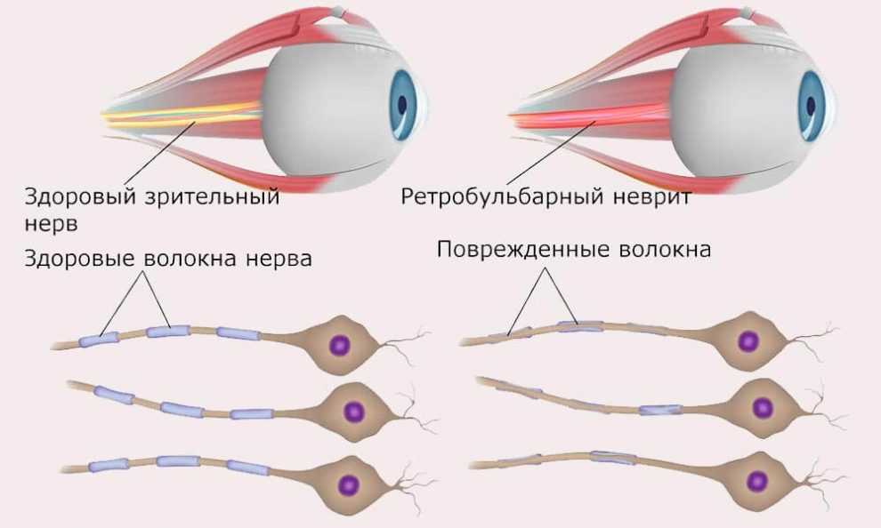 Зрительный нерв нормальный и при ретробульбарном неврите