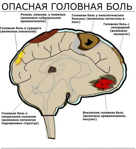 Виды головной боли в картинках по локализации