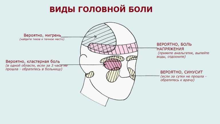 Зоны головной боли и что означают картинки