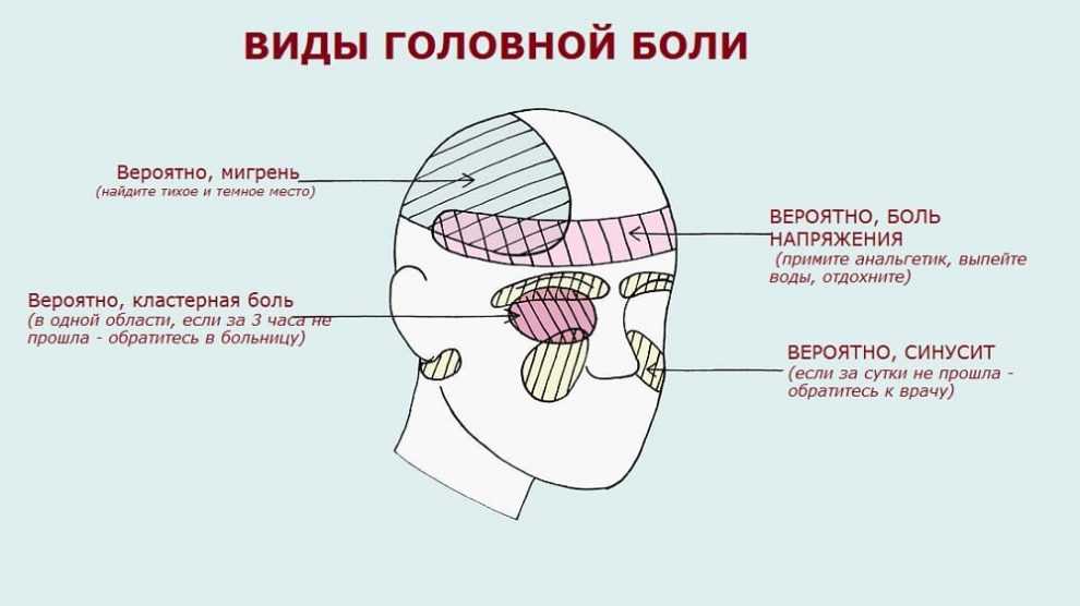 Классификация головной боли по локализации фото