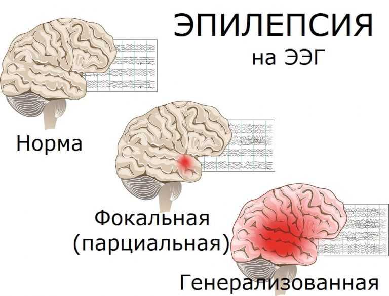 Карта вызова смп эпилепсия состояние после приступа