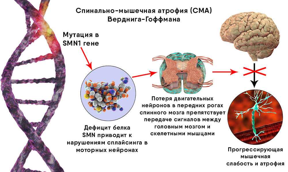 Амиотрофия Вердинга-Гоффмана