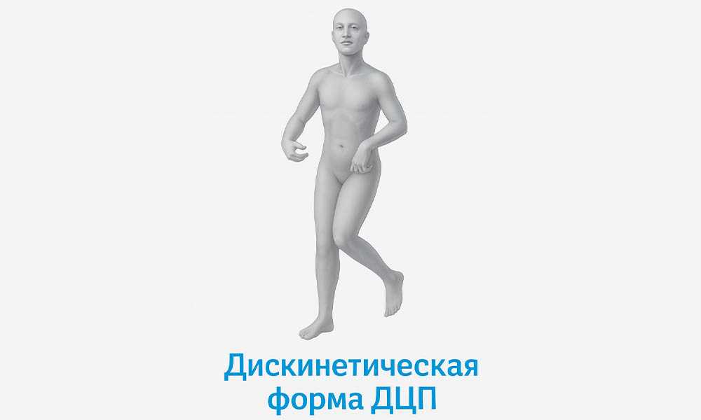 Дискинетическая форма ДЦП