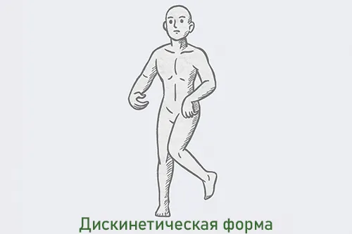 Дискинетический церебральный паралич и особенности двигательного развития при ДЦП