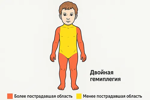 Спастический церебральный паралич и особенности двигательного развития при ДЦП