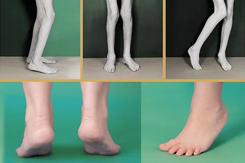 Нарушения походки при спастической диплегии